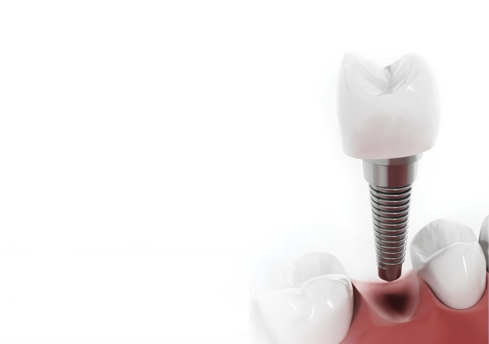 زراعة الأسنان لكبار السن