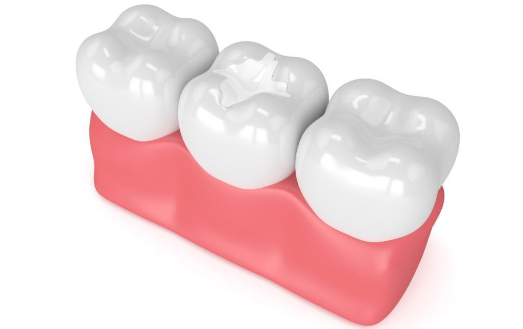 حشوات الأسنان التجميلية